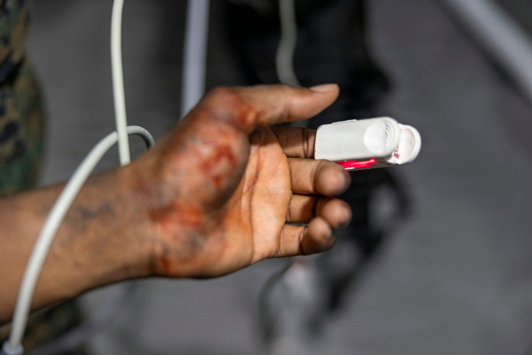A pulse oximeter clipped to a finger, with healing abrasions on the hand
